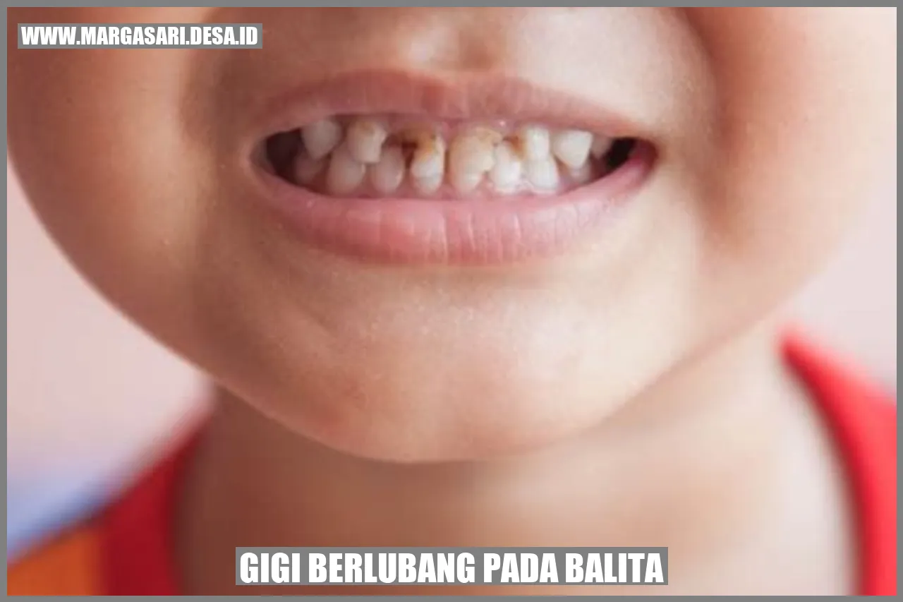 Gigi Berlubang pada Balita