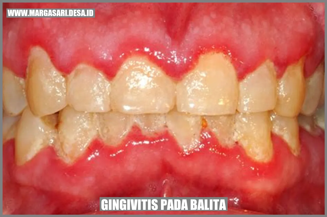 Gingivitis pada Balita