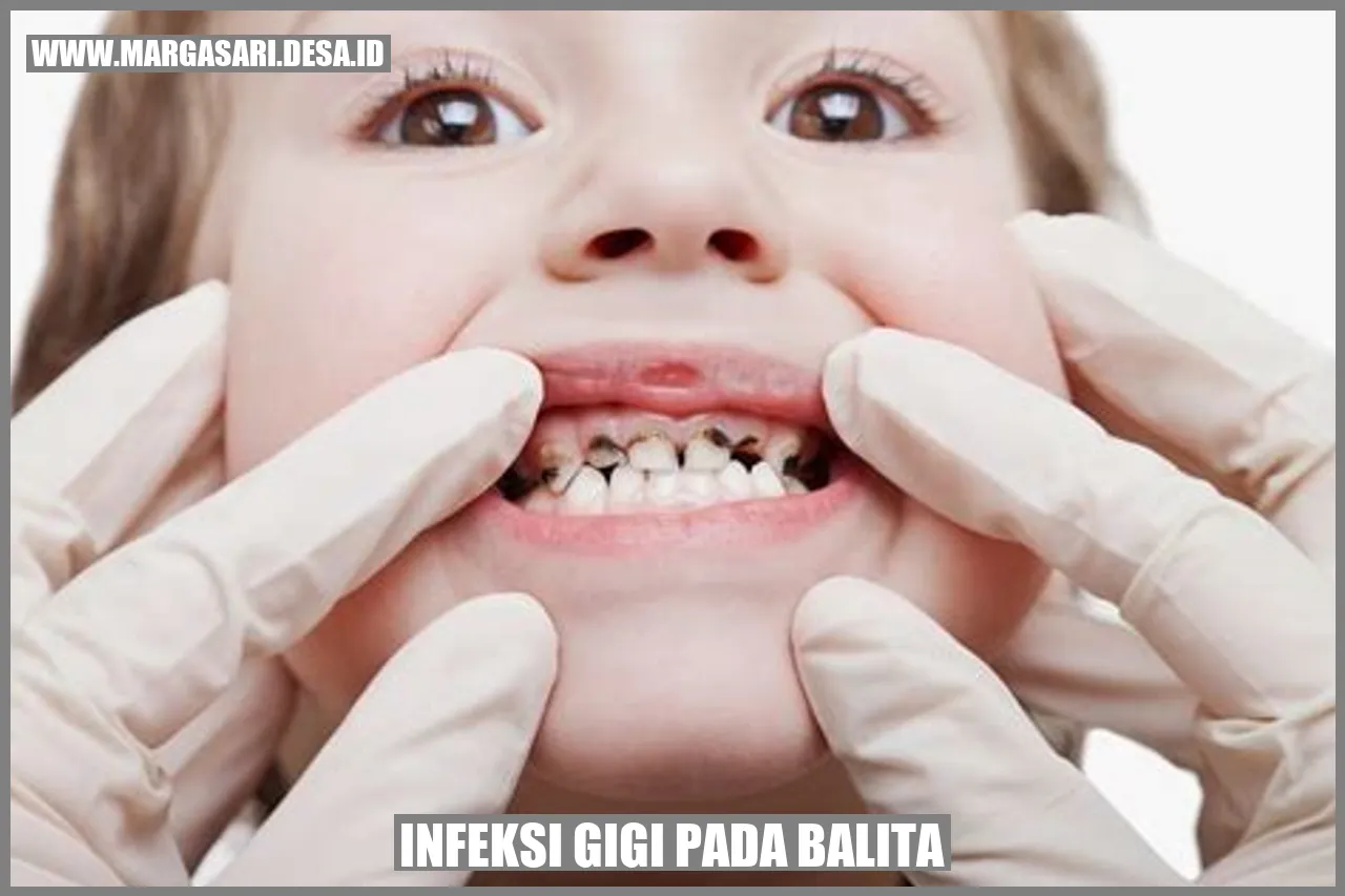 Infeksi Gigi pada Balita